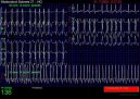 Koky: Veterinrn poradna > Fibrilace sn (Veterinrn zkroky)